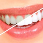 How Mineral Content in Water Influences Your Teeth Whitening Outcomes