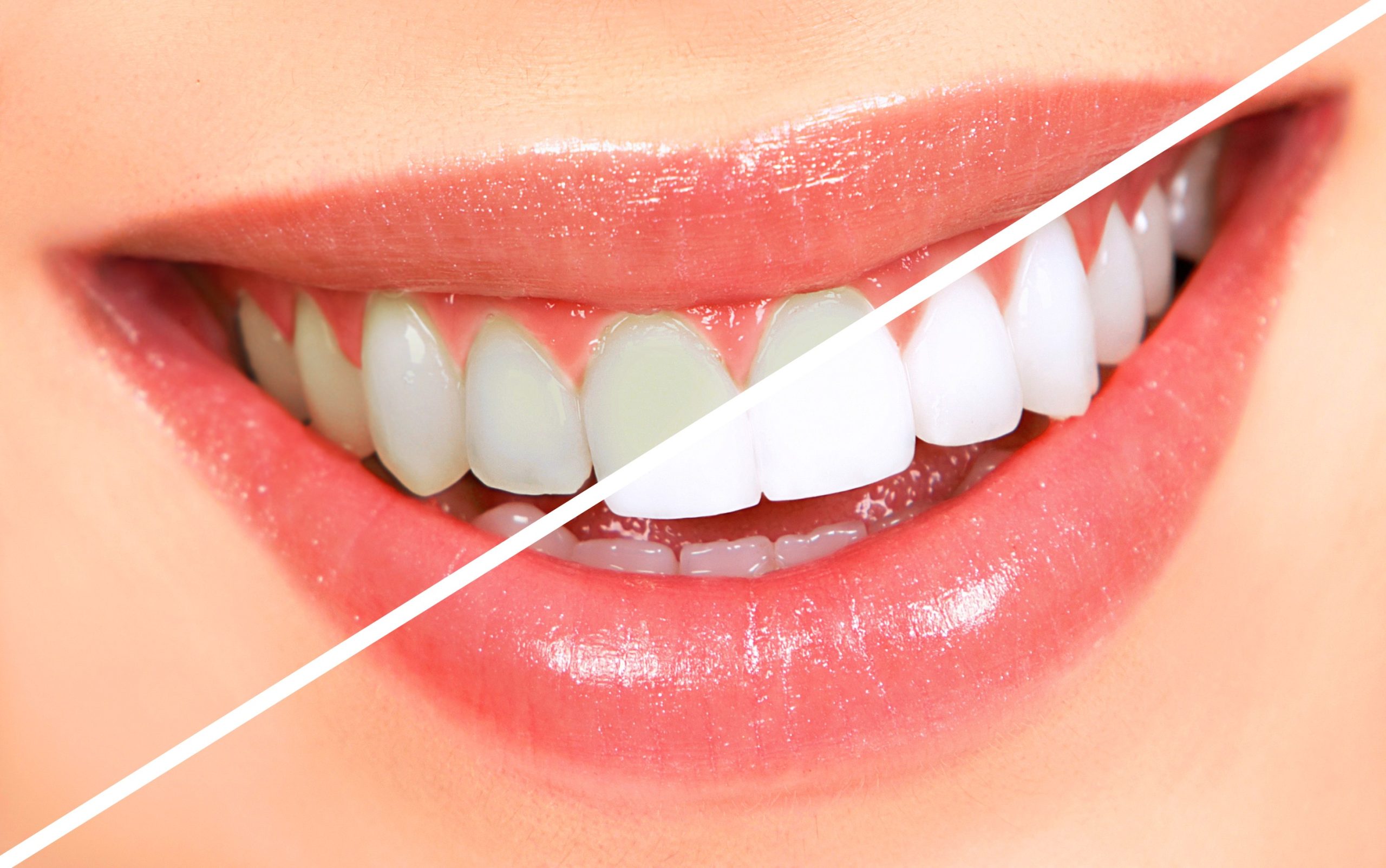How Mineral Content in Water Influences Your Teeth Whitening Outcomes
